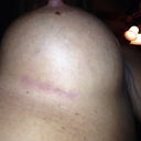 Remember the camera was right next to the incision.  This is 4 months later and really you can't see a thing unless your the camera!!