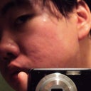 August 11, 2012 - Two weeks after second procedure

Right side of my face reflected in a mirror.