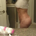 18 DAYS POST OP