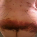 Postop Day 5 lipo bruising