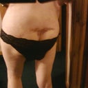 Post Op Week 2 lipo bruising much improved