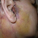 Ear infection. Nov 2010.