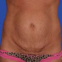 Before Tummy Tuck