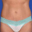 After Tummy Tuck