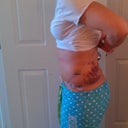 Post Op day# 7 (1 week)