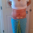Post op day# 7 (1 week)