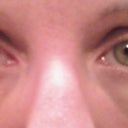Here are my eyes now, 15 months post procedure