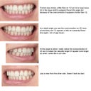 The email I sent my ortho included this to explain my issues with the results. You can clearly see what's wrong.