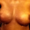 3 days after removal and total capuslectomy!  they are swollen and bruised