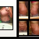 The one pic on the left is one week post op, sorry for  only one pic just wasn't feeling adding more. The pics on the right are two weeks post op at several different views. Dont might the spots on the mirror as my kids havent figured out how to brush their teeth without getting it all over the mirror...