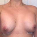 DAY POST OP