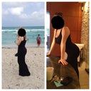 6 days post op. south Beach then back at Perry's office. The booty is juicy. I've cut my Carmen's more to avoid that weird upper booty bulge and now it looks perfect!!!