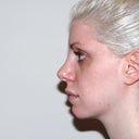 6 months post-op