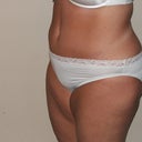 47 Days Post Op (almost 7 weeks)