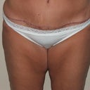 47 Days Post Op (almost 7 weeks) Scar