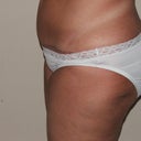 47 Days Post Op (almost 7 weeks)