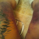 POD 2thighs- bruising is worse today, legs are VERY swollen!