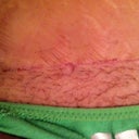 scar is healing perfect this is the 2 week mark I can only imagine how unnoticable it will be at 2 years