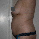 Pre-op Side