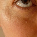 6 months after the procedure.  Notice the general atrophy (skin sinking), wrinkling, bumpy texture, and think skin.  There is an indentation from fat loss under the eye (the red area).