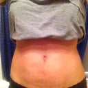 Post op 3 weeks