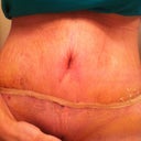 My belly button that's swollen shut almost.  Not sure what it's doing actually.