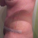 Day 16 sorry  for all the wrinkles just woke up and I wear all my compression to bed