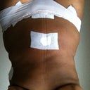 one week postop