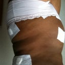 one week postop side