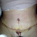 Incision is low:)
