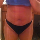 2 days prior to surgery
