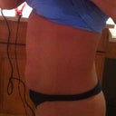 Side view 2 days prior to surgery