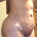 THE V SHAPED SCAR! THE LUMPS!