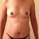 Pre-op front view
