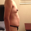 Notice me elongated left nipple, pre nipple reduction!