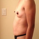 Pre-op left side view