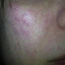 12 hours after 1st IPL procedure. Right side of face, cheek area - my scar isn't too noticeable here but it's there (kind of where the shine is) right under my eye on my cheek. My cheeks seem to be sensitive.
