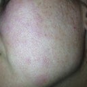 12 hours after 1st IPL procedure. Left cheek, sun damage probably from driving. Slightly darker than it was before.