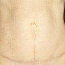 6 months post-op.  Love it!