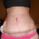 2 weeks post op