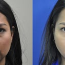 36 Year Old Female Treated For Weak Chin, Double Chin, And Excess Buccal Fat