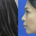 36 Year Old Female Treated For Weak Chin, Double Chin, And Excess Buccal Fat