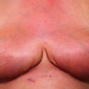 18 days post op.