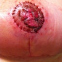 Left nipple graft 18 days post op. top layer of skin is peeling.