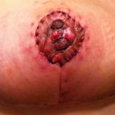 Right nipple graft 18 days post op. top layer of skin is peeling