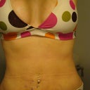 Here you can see the marks he made where he drained my seroma.  It has filled back up a little so it isn't as flat as it will be once I am all healed.