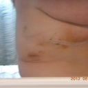 Bruising from the lipo I had under my arms. Nothing serious though. All that ugliness from before was just some drainage trapped under the tapes :)