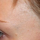 1 year later. The area around my eye where there was no laser is smooth.
