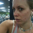 Before peel, trouble with acne