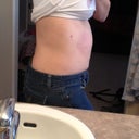 Day of Upper stomach: You can see the swelling.